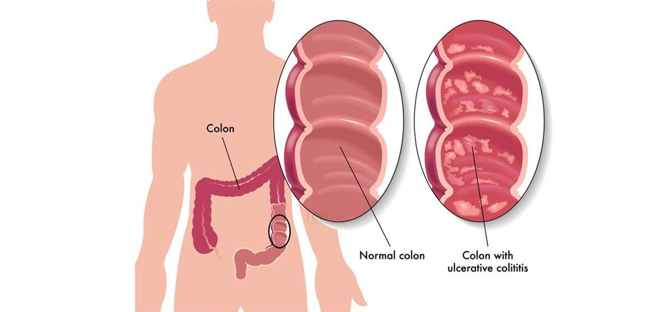 The Neural Therapy Approach to Ulcerative Colitis The role and importance of NEURAL THERAPY in the acute and chronic diseases of the large intestine is becoming better understood with every passing day.