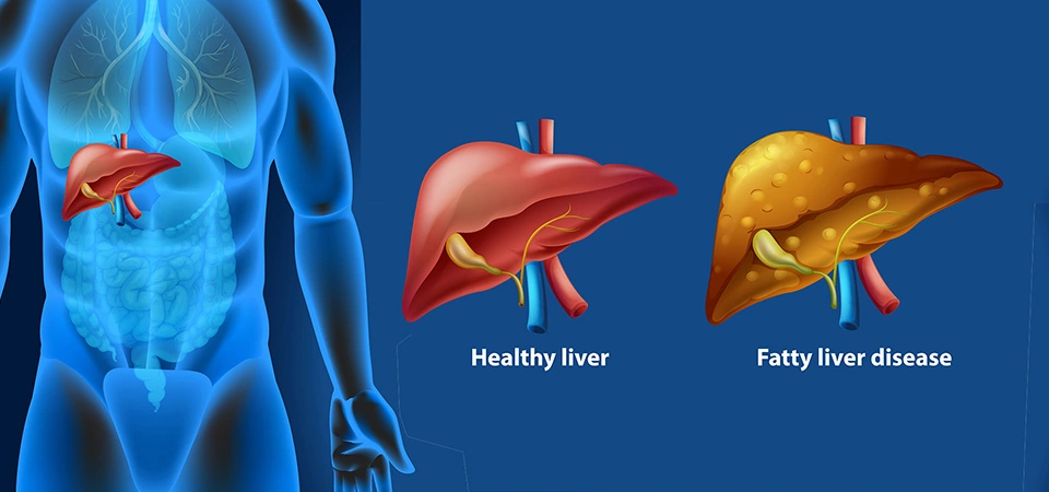 Fatty Liver Disease and Kidney Disease: The Mysterious Connection in Your Gut