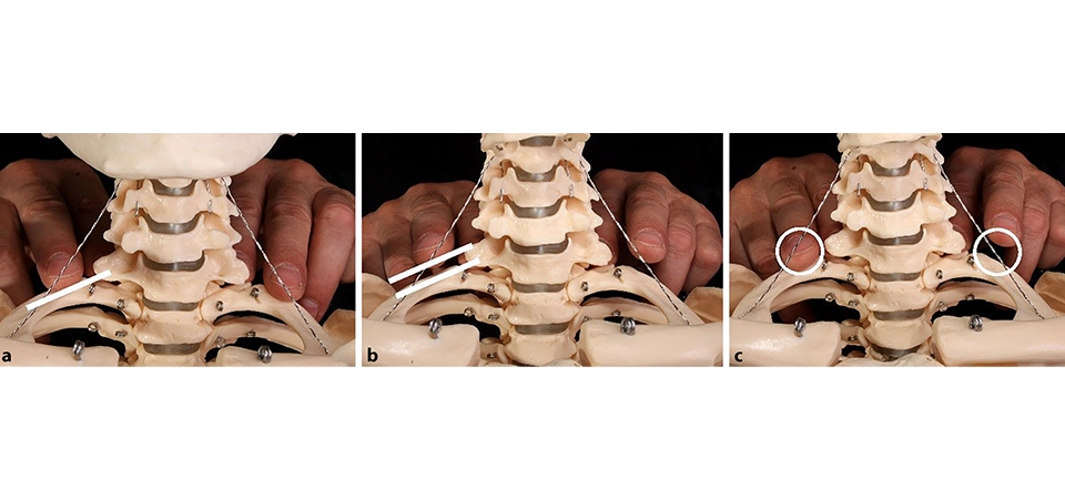 Diagnosis and Treatment of the First Rib: A New Technique Hüseyin Nazlikul 1,2,3,4 - Fatma Gülçin Ural Nazlikul 4,5
